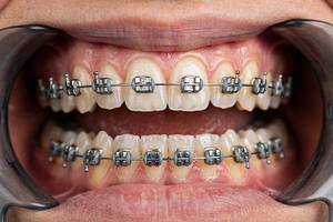 Braces